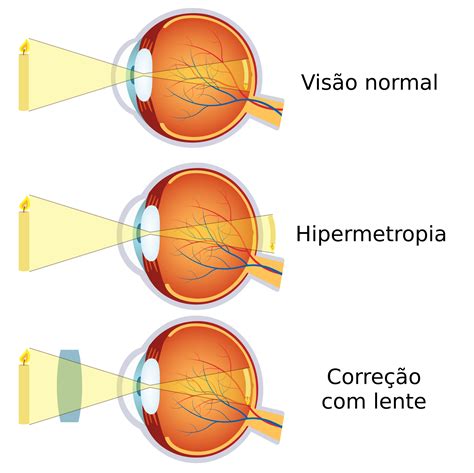 hipermetropia e astigmatismo